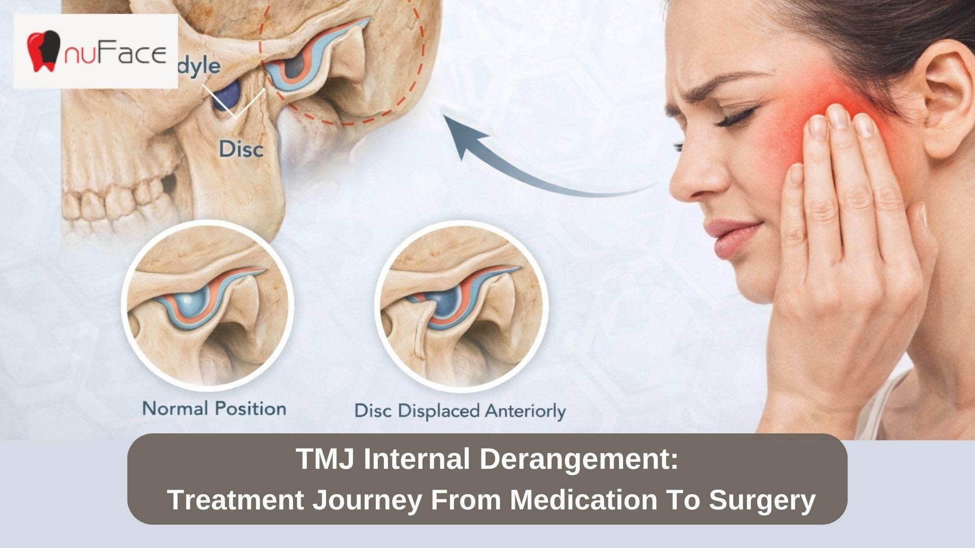 TMJ Internal Derangement