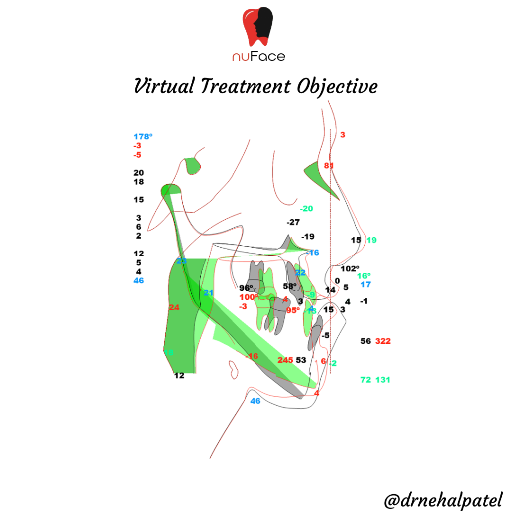 2D cephalometric VTO simulation used to plan orthognathic jaw surgery at nuFace Hospital, Surat