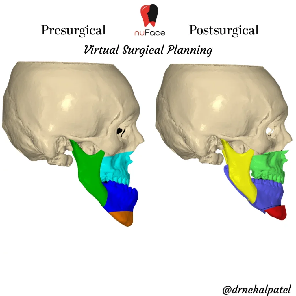 3D virtual surgical planning scan, lateral view, comparing pre-planning and post-planning jaw position for orthognathic surgery at nuFace Hospital