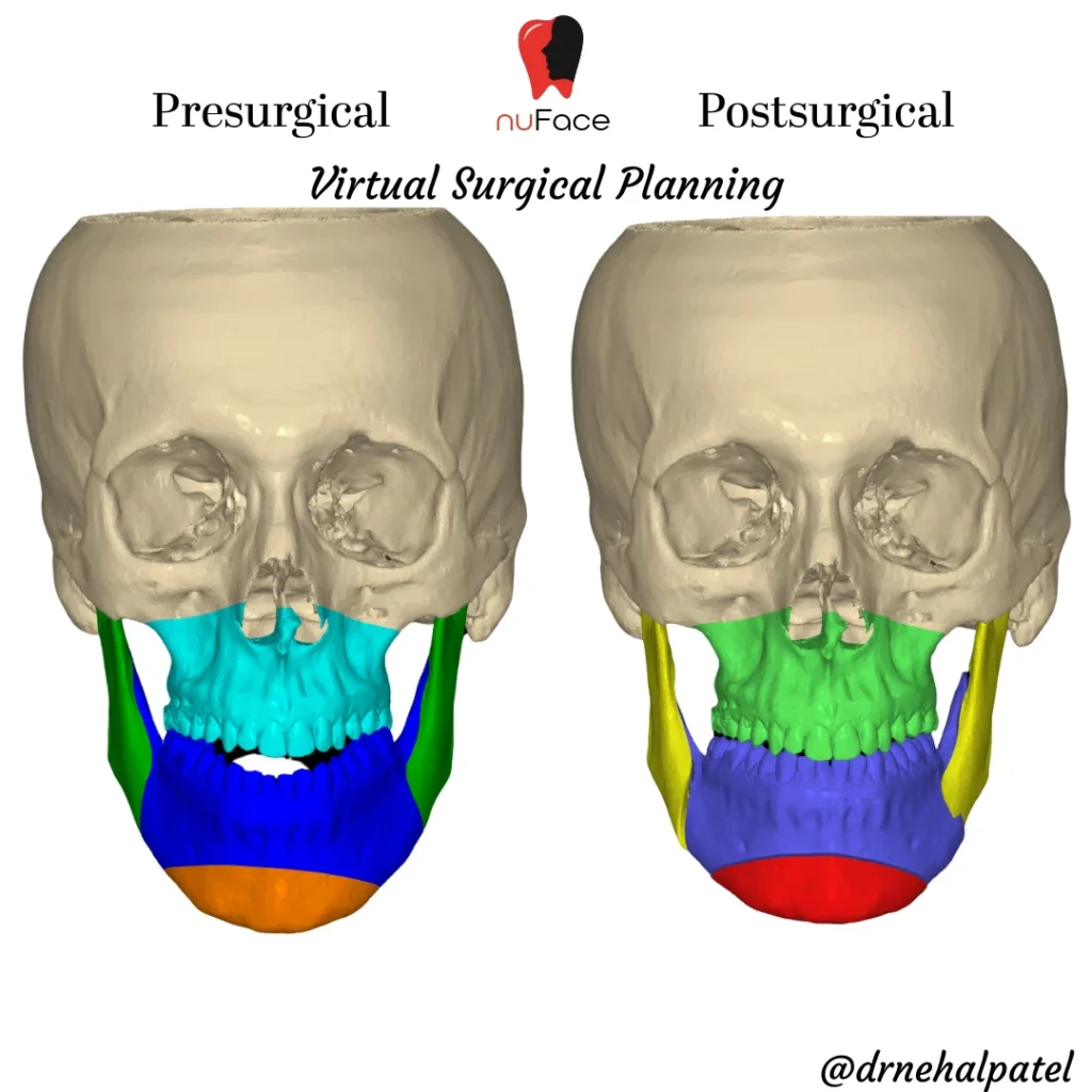 3D virtual surgical planning scan, frontal view, used to plan corrective jaw surgery outcomes at nuFace Hospital
