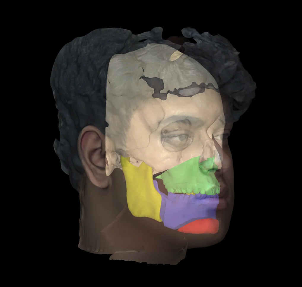 3D digital rendering of the jawbone used for orthognathic (corrective jaw) surgery planning at nuFace Hospital