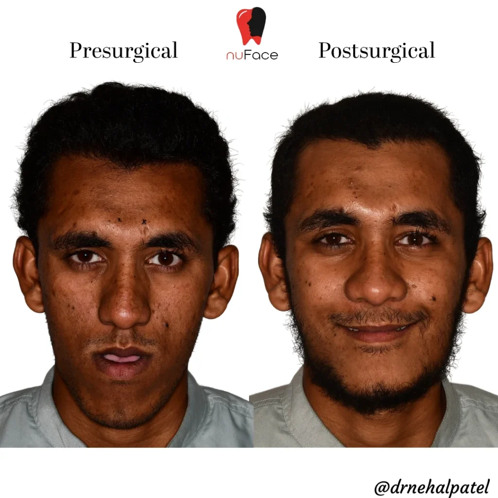 Frontal view before and after orthognathic jaw surgery at nuFace Hospital, Surat