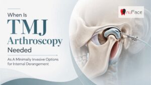 Illustration of TMJ arthroscopy with an arthroscope inserted into the temporomandibular joint