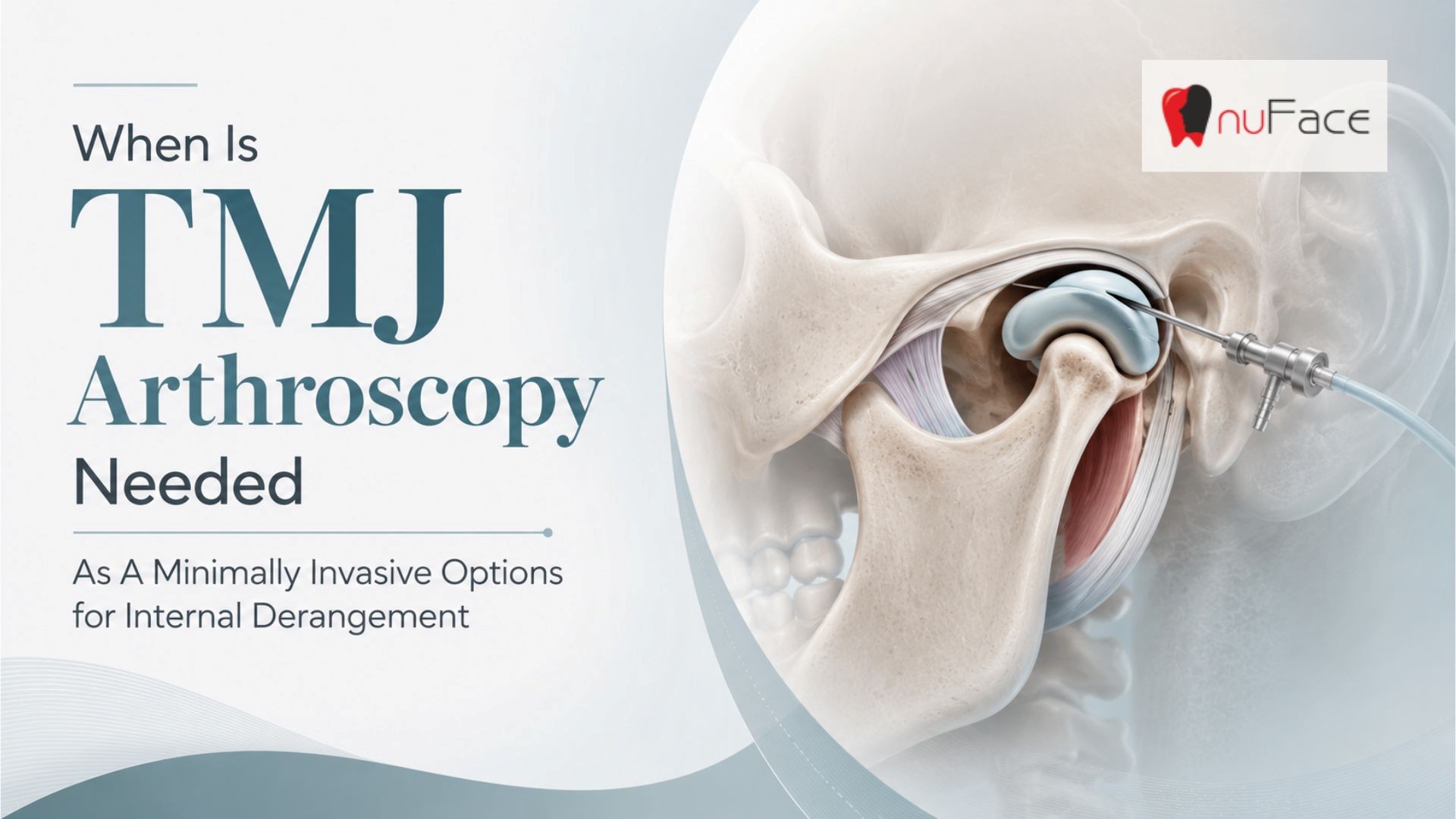 Illustration of TMJ arthroscopy with an arthroscope inserted into the temporomandibular joint