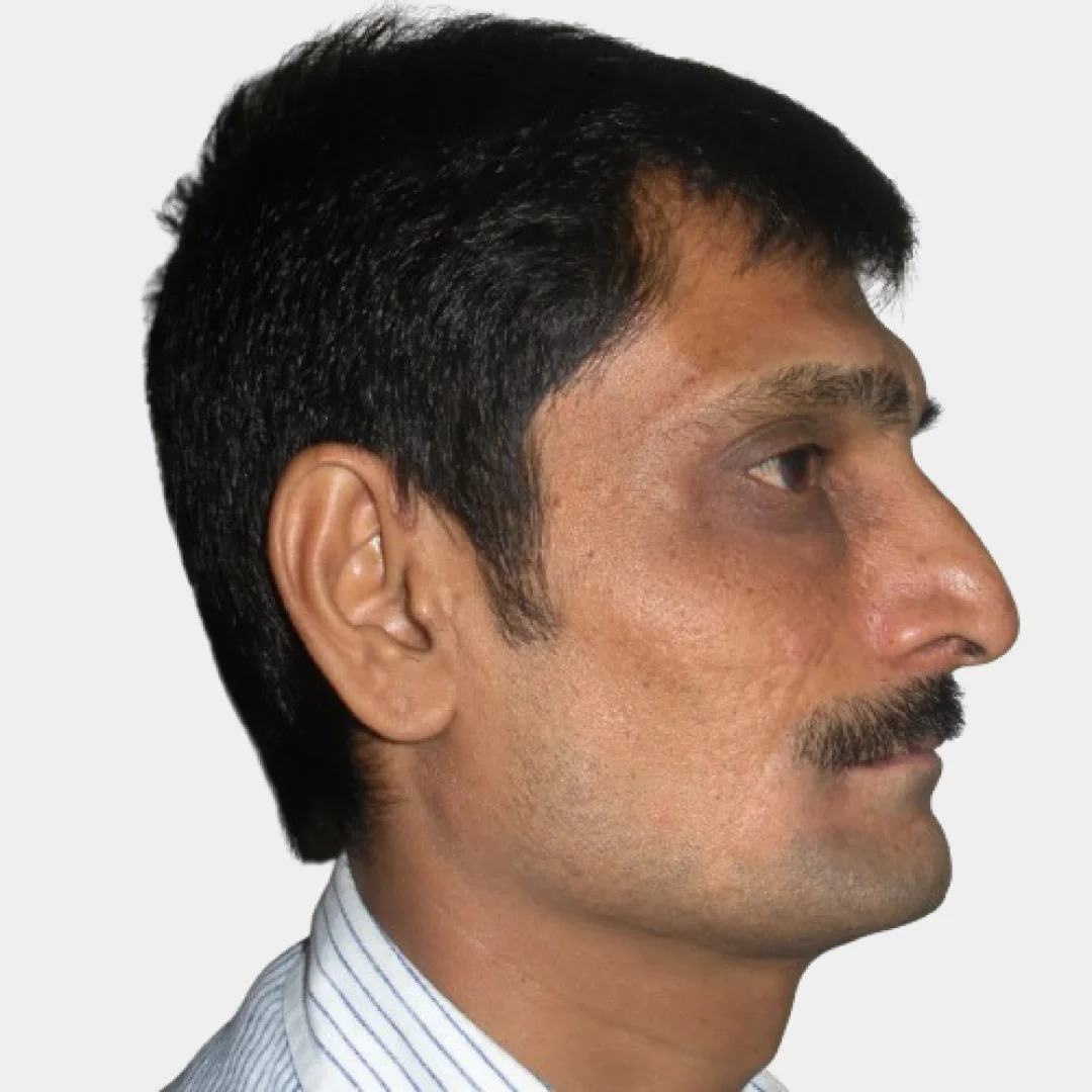 Profile view of the same nuFace Hospital patient after oral and maxillofacial surgery in Surat