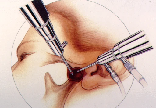 Illustration of TMJ arthroscopy surgical instruments used in minimally invasive jaw joint surgery at nuFace Hospital, Surat