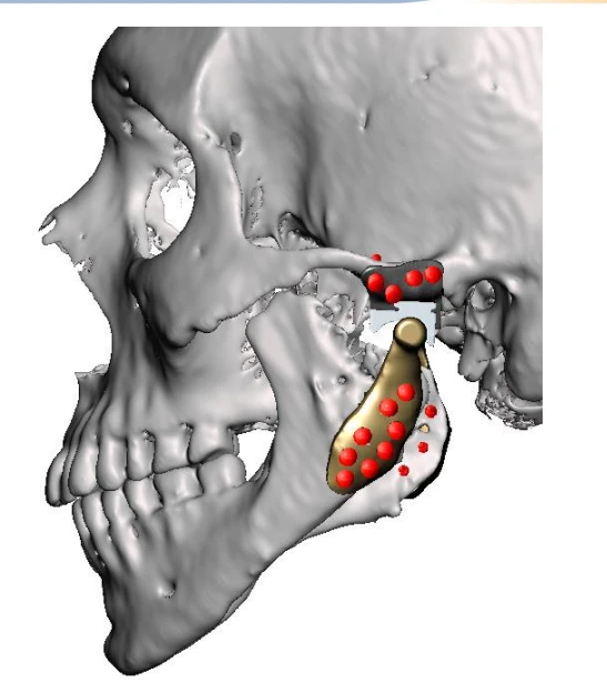 3D CT scan model showing a total TMJ (temporomandibular joint) replacement implant used at nuFace Hospital, Surat