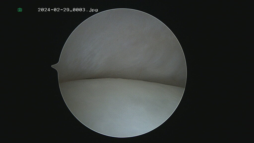 Intra-articular view of the TMJ