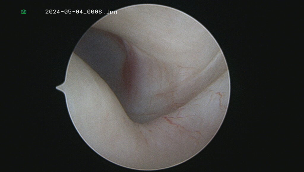 Arthroscopic view during TMJ surgery