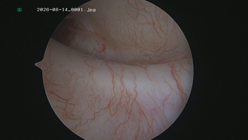 View of joint tissue via 1.9mm arthroscope